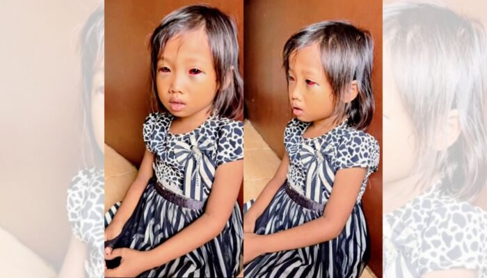 Diduga Alami Kekerasan di Sekolah, Siswa SD di Gandus Alami Luka di Area Mata